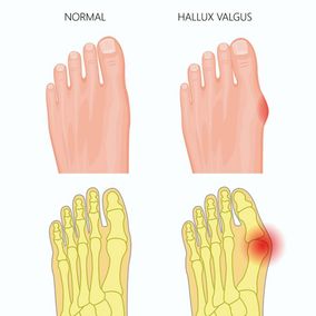 Sika Footwear: Für mehr Zehenfreiheit - Neue Sicherheitsschuh-Lösung
